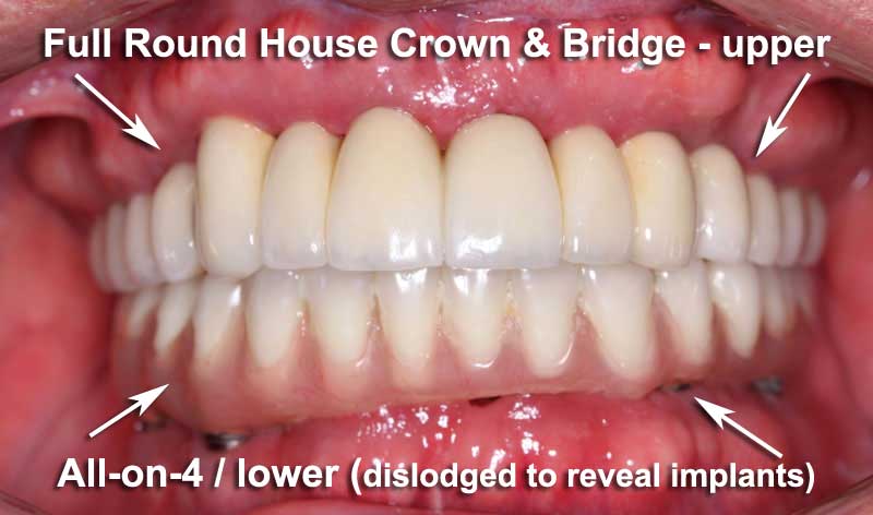 Full Round House Crown & Bridge