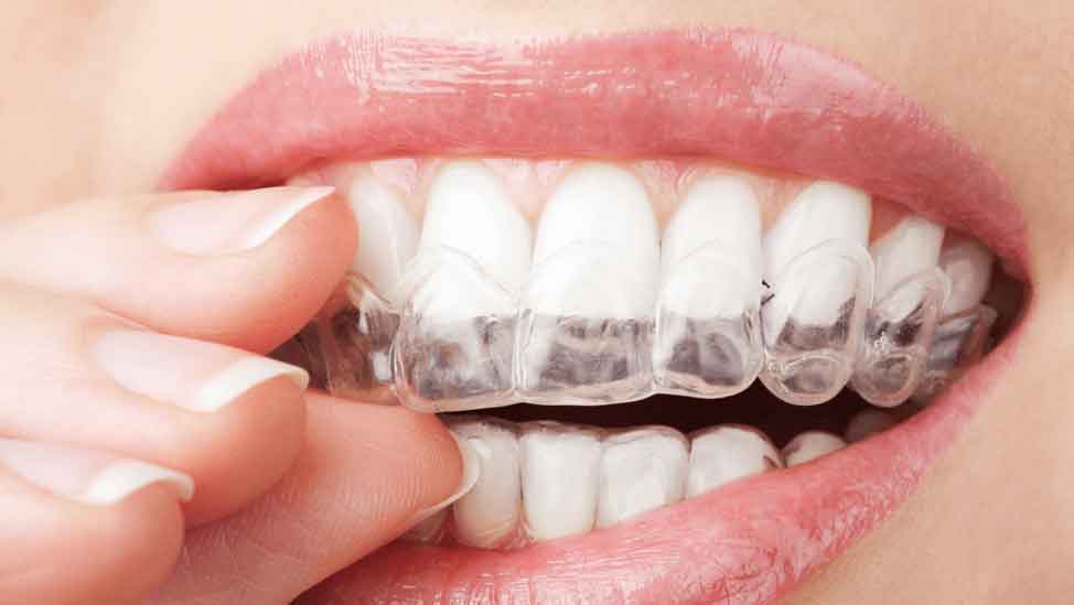 Invisalign